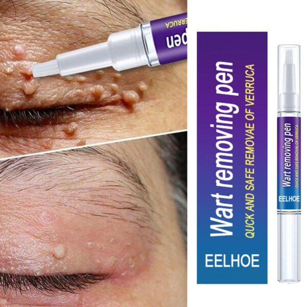 WART REMOVER PEN